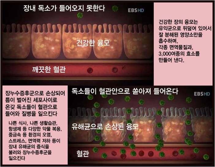 장누수증후군 설명 이미지