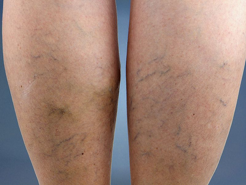 하지정맥류 원인과 증상 설명 인포그래픽