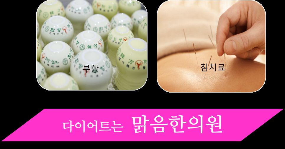 다이어트 부항 치료 안내